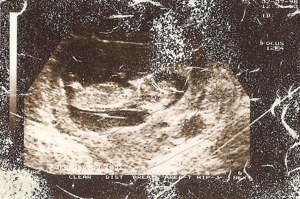 Echographie du 7ème mois